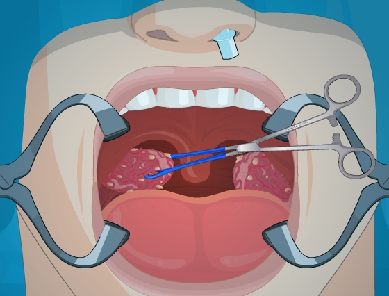 Play Tonsil Surgery Game